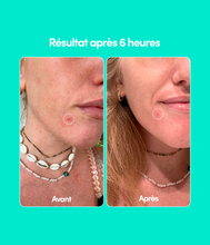 Free samples blemish patches x6