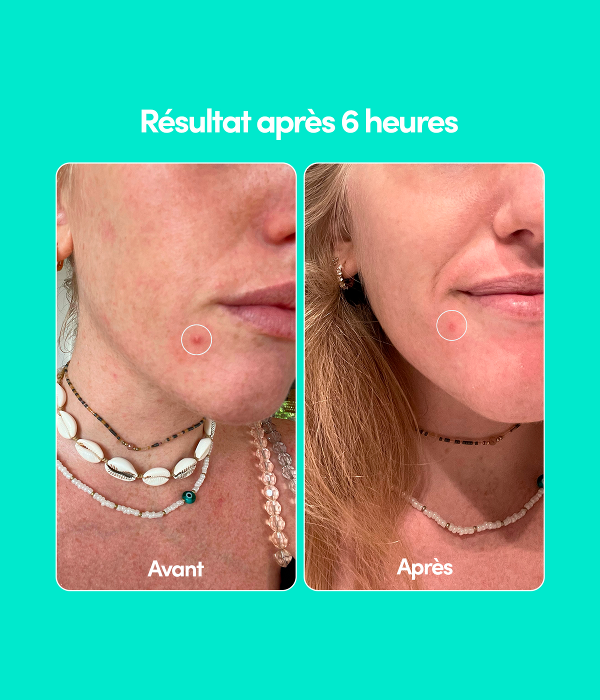 24 Pimple Patches